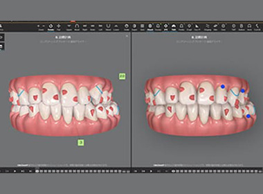 矯正完了までの歯の動きを確認できる
